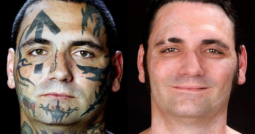 tatuaże neonazistów usuwanie laserowe