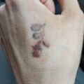 Usuwanie tatuaży - Blizna po usuwaniu