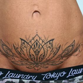 Tattoo Healed scar cover-up on the stomach motif: cover-up style: contour / linework